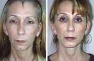 Facelift and Chin Implant