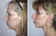 Facelift and Chin Implant