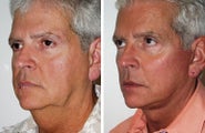 Facelift with dermabrasion