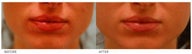 Lip Reduction/Lip Correction