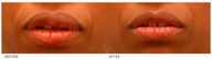 Lip Reduction/Lip Correction
