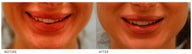Lip Reduction/Lip Correction