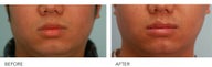 Lip Reduction/Lip Correction