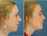 Rhinoplasty with Chin Implant young girl