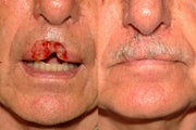 Lip Reconstruction
