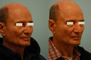 Facial Reconstruction