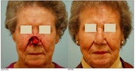 Facial Reconstruction