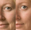 Hyperbaric Oxygen Facial 