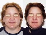 Clay Masque Treatment