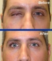 Socket surgery (prosthetic eye)