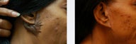 Keloid Repair