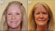 Facial Paralysis and Reconstruction