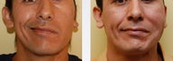 Facial Paralysis and Reconstruction
