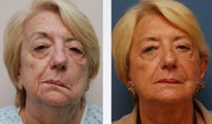 Facial Paralysis Reconstruction and Facelift
