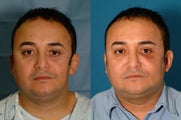 Fat transfer/fat graft