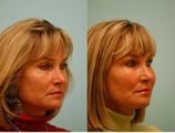 Fat Transfer/Fat Grafting/Facial Rejuvenation