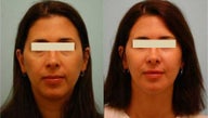 Fat Transfer/Fat Grafting/Facial Rejuvenation