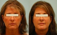 Fat Transfer/Fat Grafting/Facial Rejuvenation