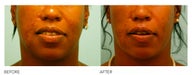 Fat Transfer/Fat Grafting/Facial Rejuvenation