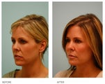 Fat Transfer/Fat Grafting/Facial Rejuvenation