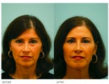Fat Transfer/Fat Grafting/Facial Rejuvenation