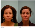 Fat Transfer/Fat Grafting/Facial Rejuvenation