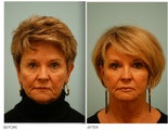 Fat Transfer/Fat Grafting/Facial Rejuvenation