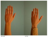 Hand Rejuvenation (with Fat Transfer)