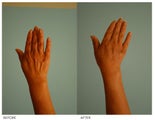 Hand Rejuvenation (with Fat Transfer)