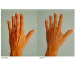 Hand Rejuvenation (with Fat Transfer)