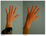 Hand Rejuvenation (with Fat Transfer)