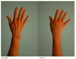 Hand Rejuvenation (with Fat Transfer)