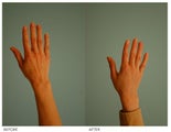 Hand Rejuvenation (with Fat Transfer)