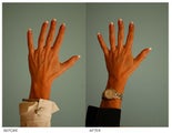 Hand Rejuvenation (with Fat Transfer)