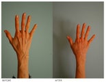 Hand Rejuvenation (with Fat Transfer)