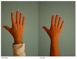 Hand Rejuvenation (with Fat Transfer)