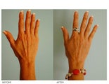 Hand Rejuvenation (with Fat Transfer)