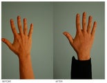 Hand Rejuvenation (with Fat Transfer)