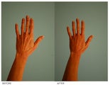 Hand Rejuvenation (with Fat Transfer)
