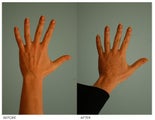 Hand Rejuvenation (with Fat Transfer)