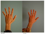 Hand Rejuvenation (with Fat Transfer)