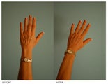 Hand Rejuvenation (with Fat Transfer)