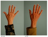 Hand Rejuvenation (with Fat Transfer)