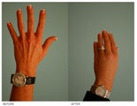 Hand Rejuvenation (with Fat Transfer)