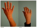 Hand Rejuvenation (with Fat Transfer)