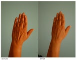 Hand Rejuvenation (with Fat Transfer)