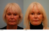 Fat Transfer/Fat Grafting/Facial Rejuvenation