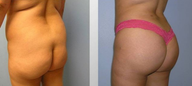 Fat transfer buttock augmentation and liposuction