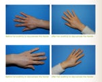 Fat Transfer to the Hands ~ YoungVolumizer Procedure