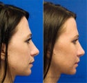 Fat Transfer